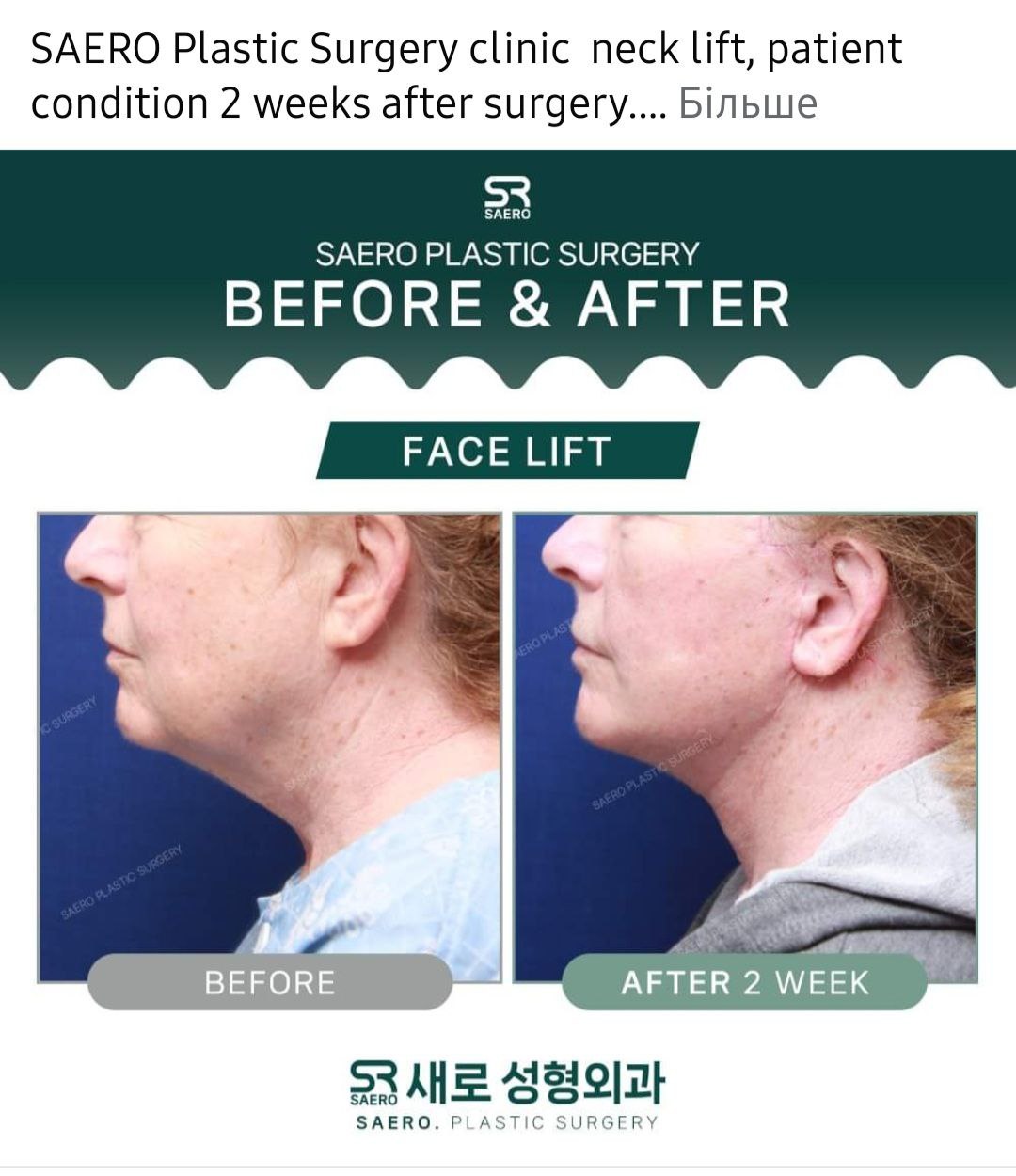 Before and after result by Dr. Park Young Kyu