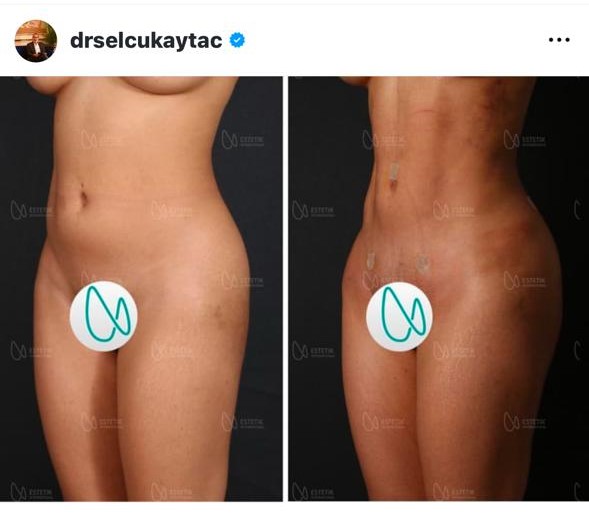 Before and after result by Dr. Selçuk Aytaç