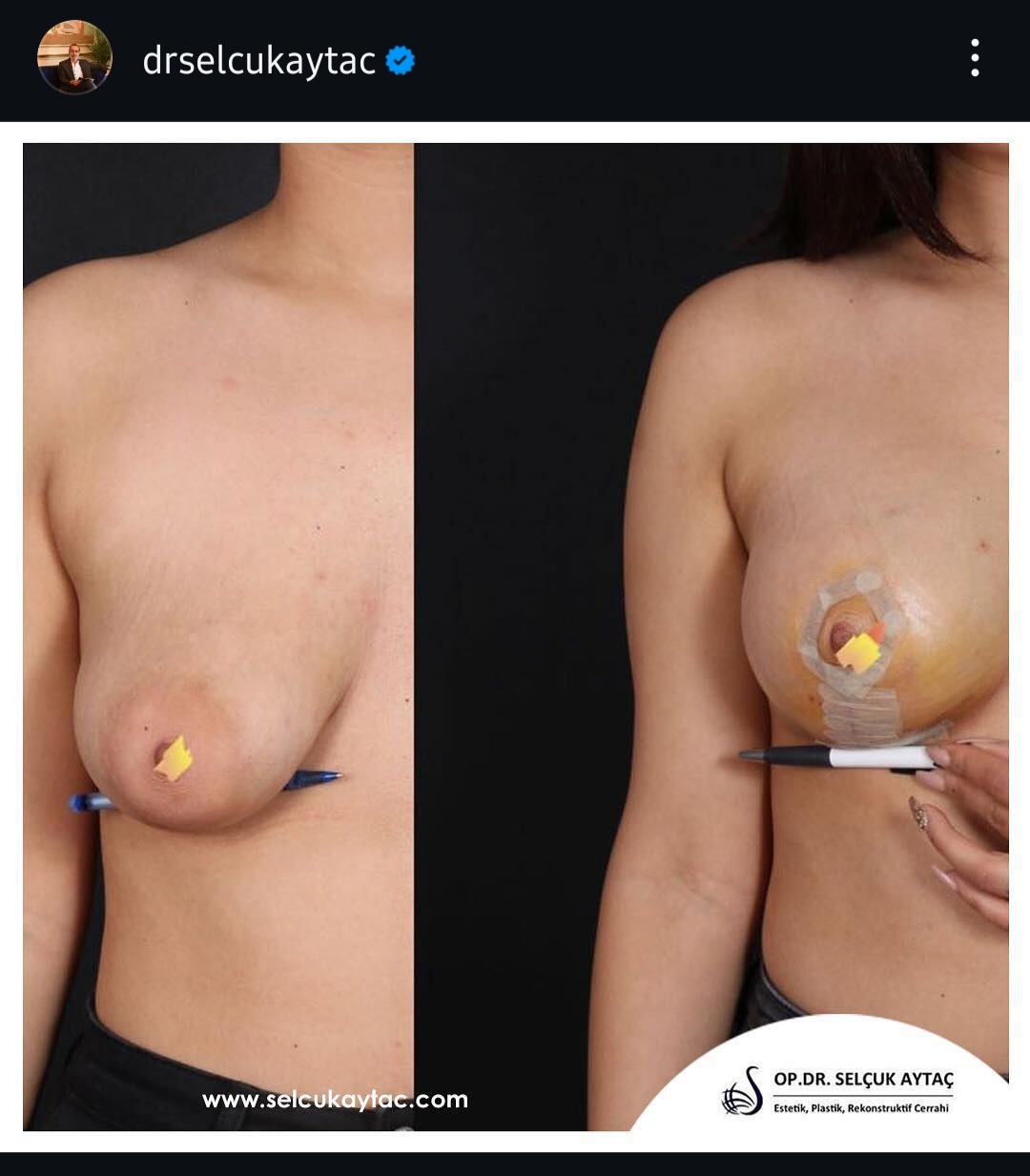 Before and after result by Dr. Selçuk Aytaç