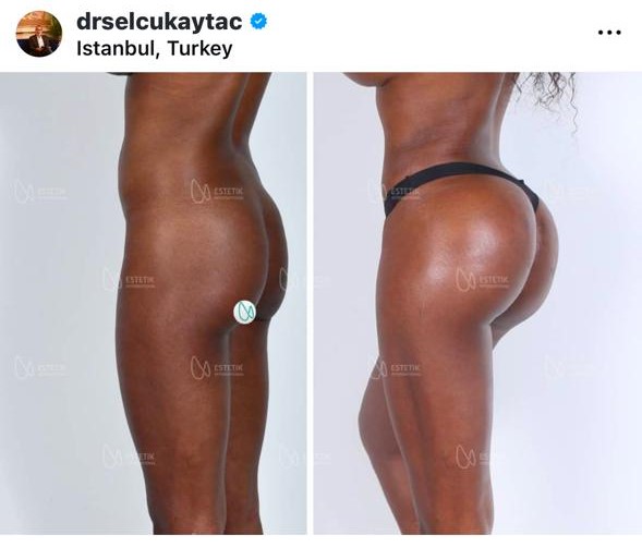 Before and after result by Dr. Selçuk Aytaç