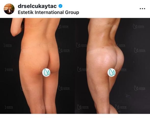 Before and after result by Dr. Selçuk Aytaç
