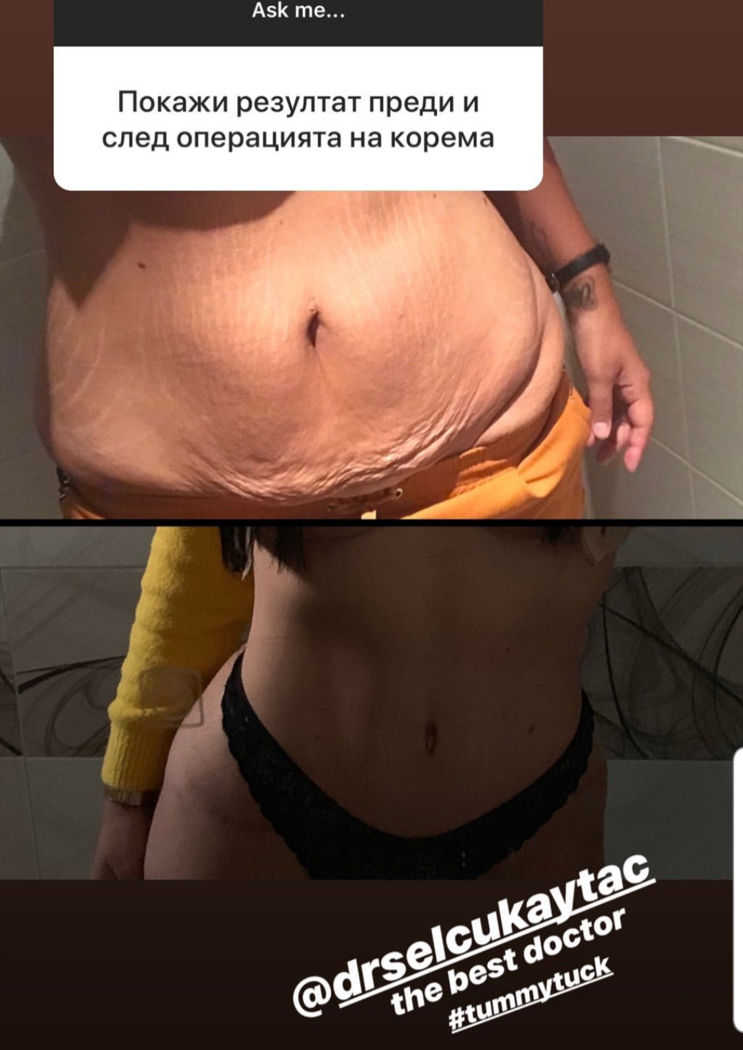 Before and after result by Dr. Selçuk Aytaç