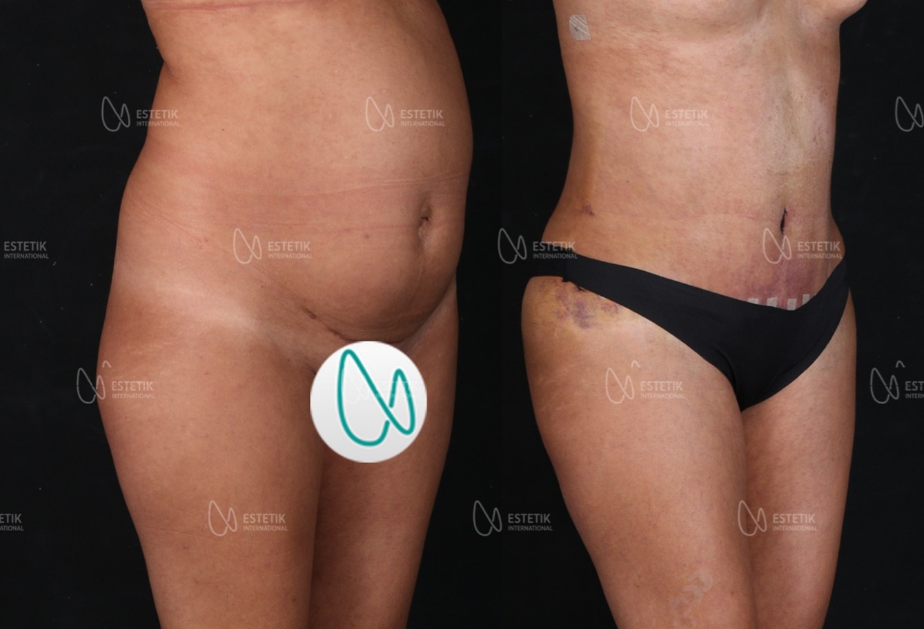Before and after result by Dr. Selçuk Aytaç