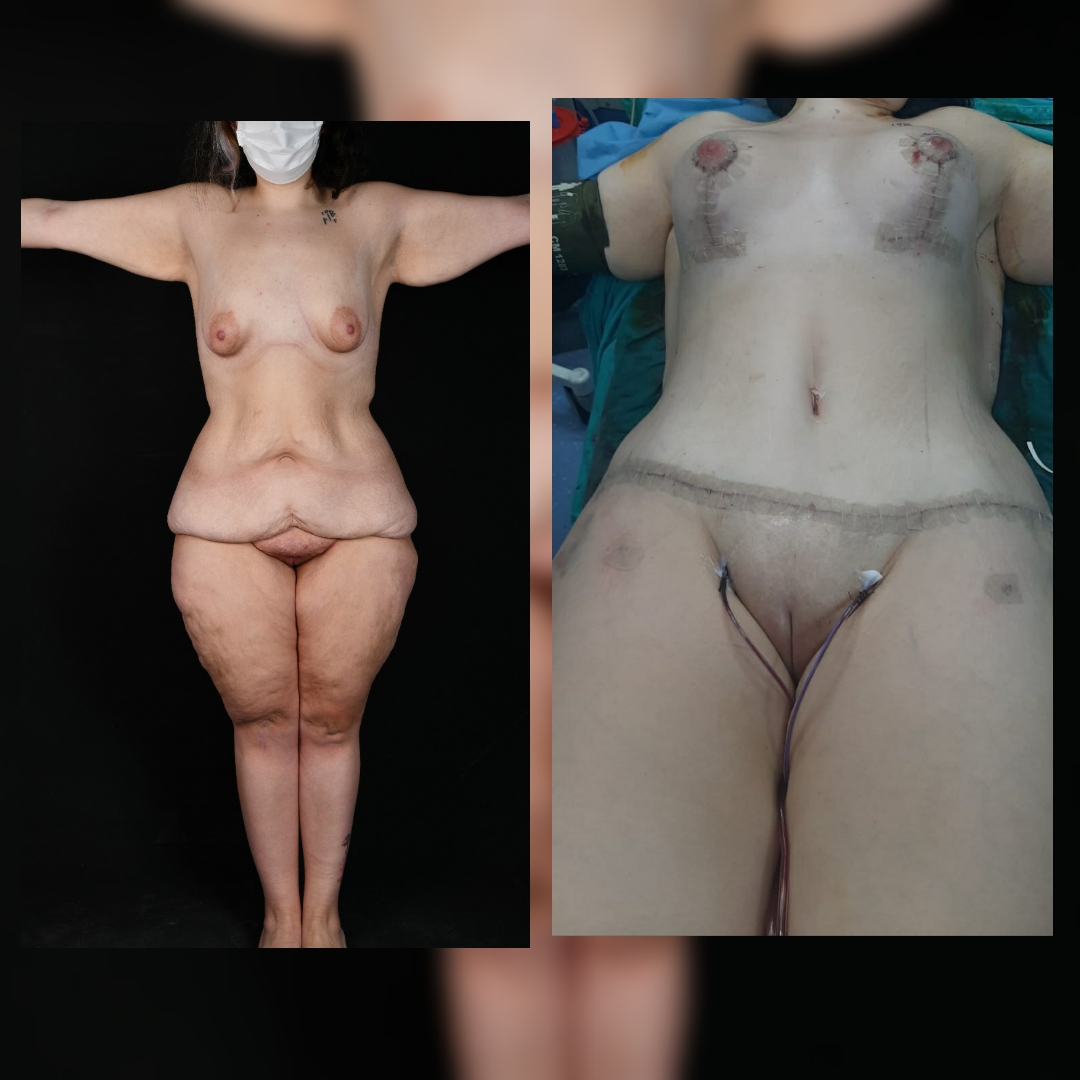 Before and after result by Dr. Selçuk Aytaç