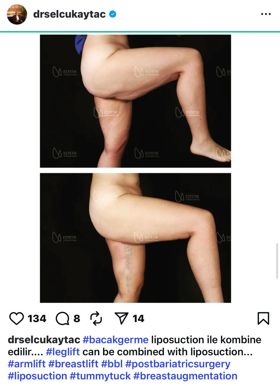 Before and after result by Dr. Selçuk Aytaç