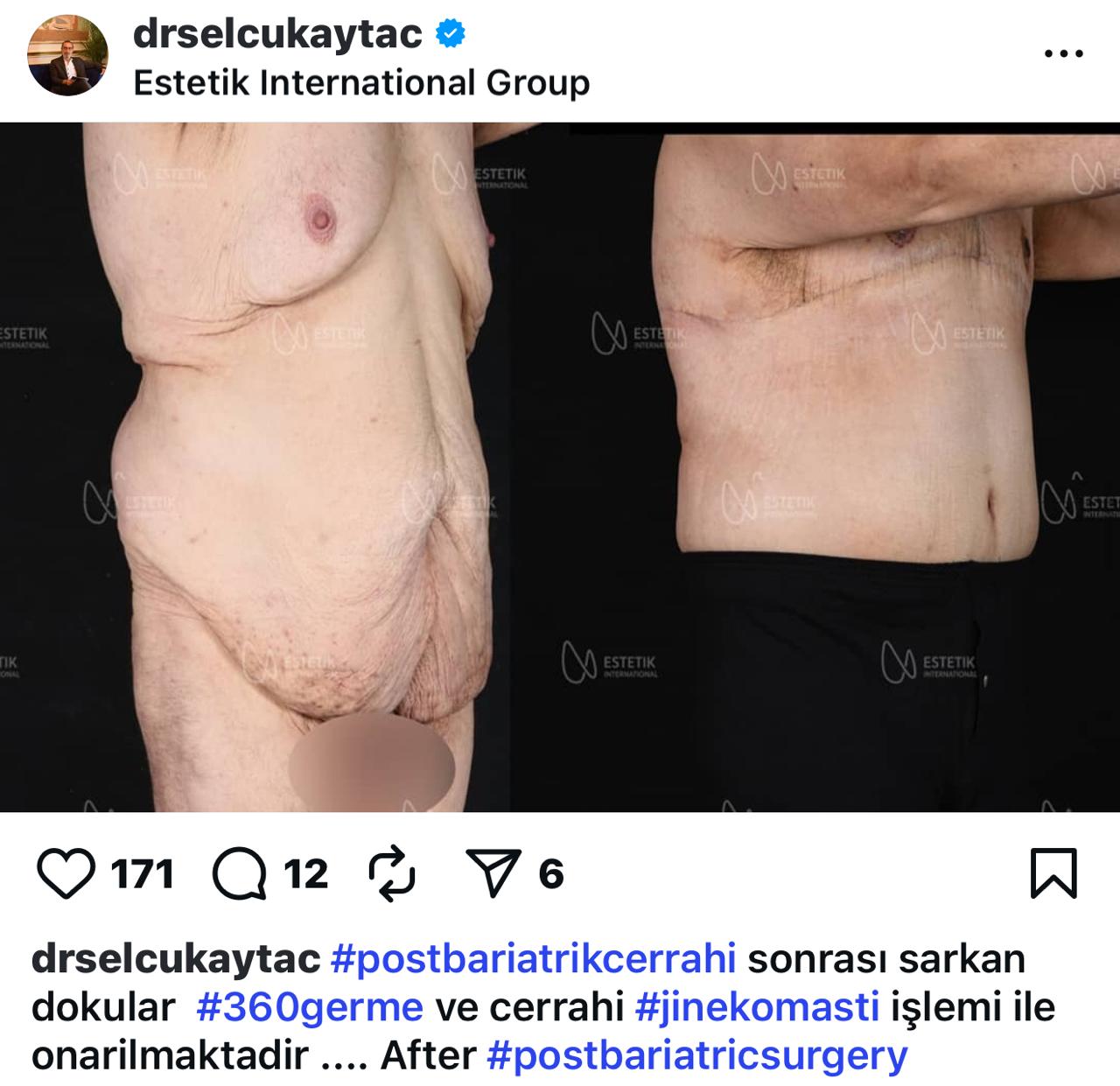 Before and after result by Dr. Selçuk Aytaç
