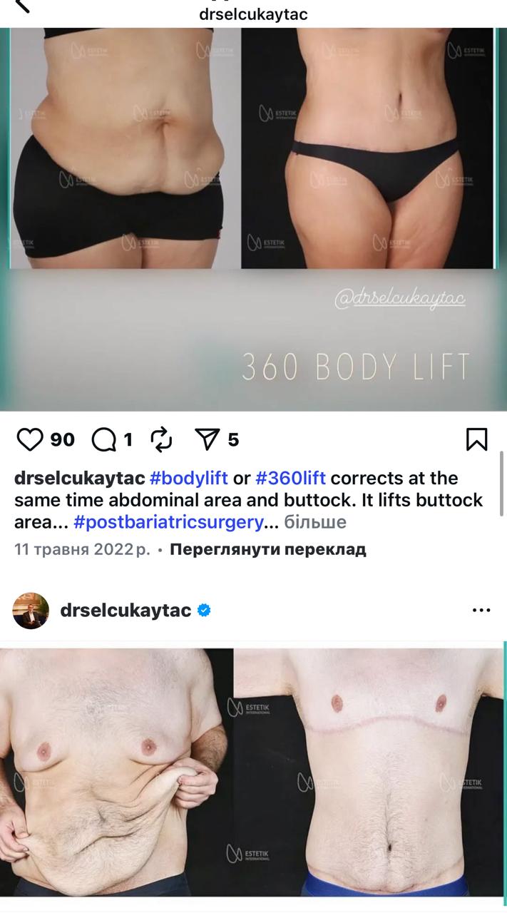 Before and after result by Dr. Selçuk Aytaç