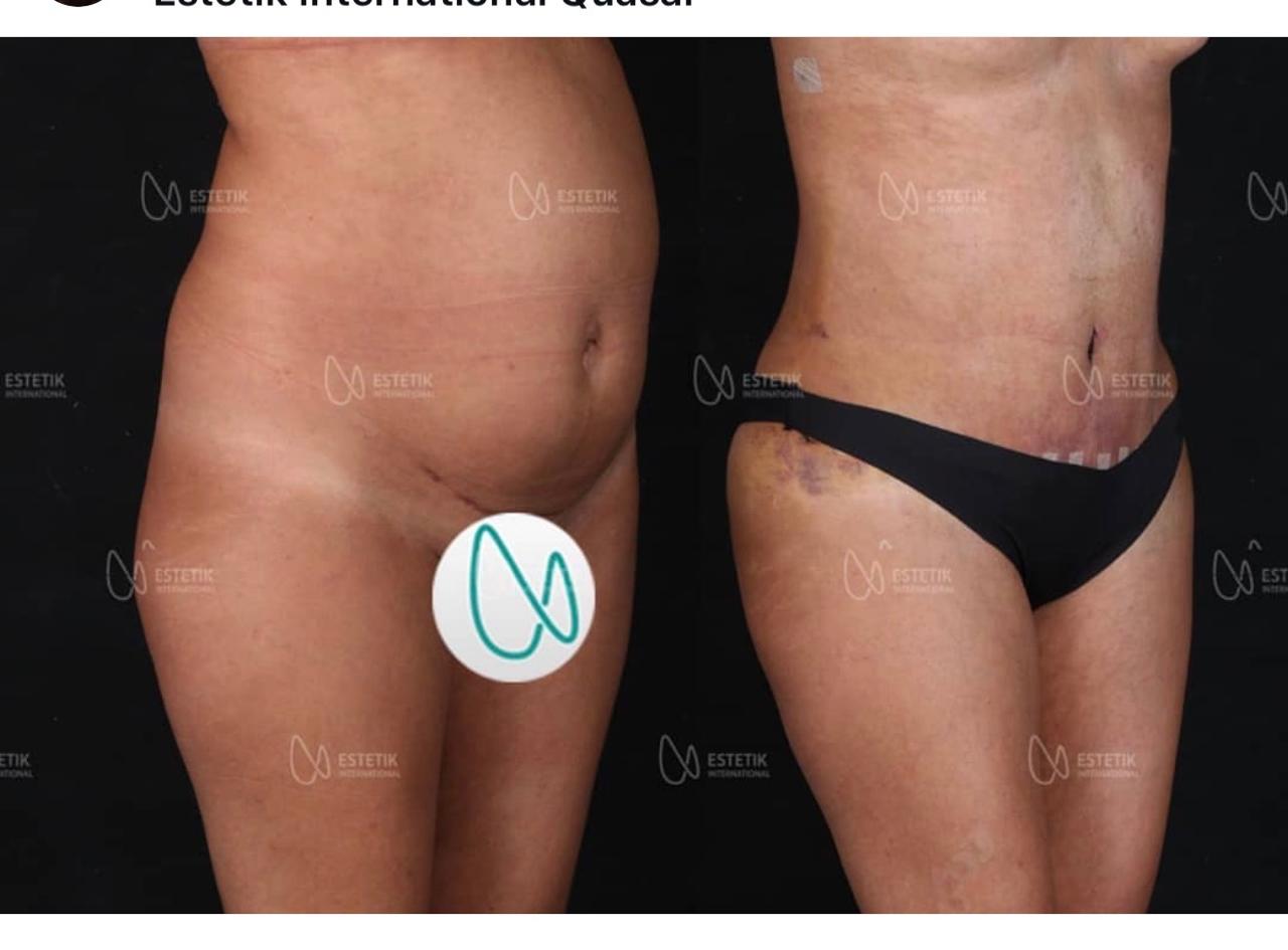 Before and after result by Dr. Selçuk Aytaç