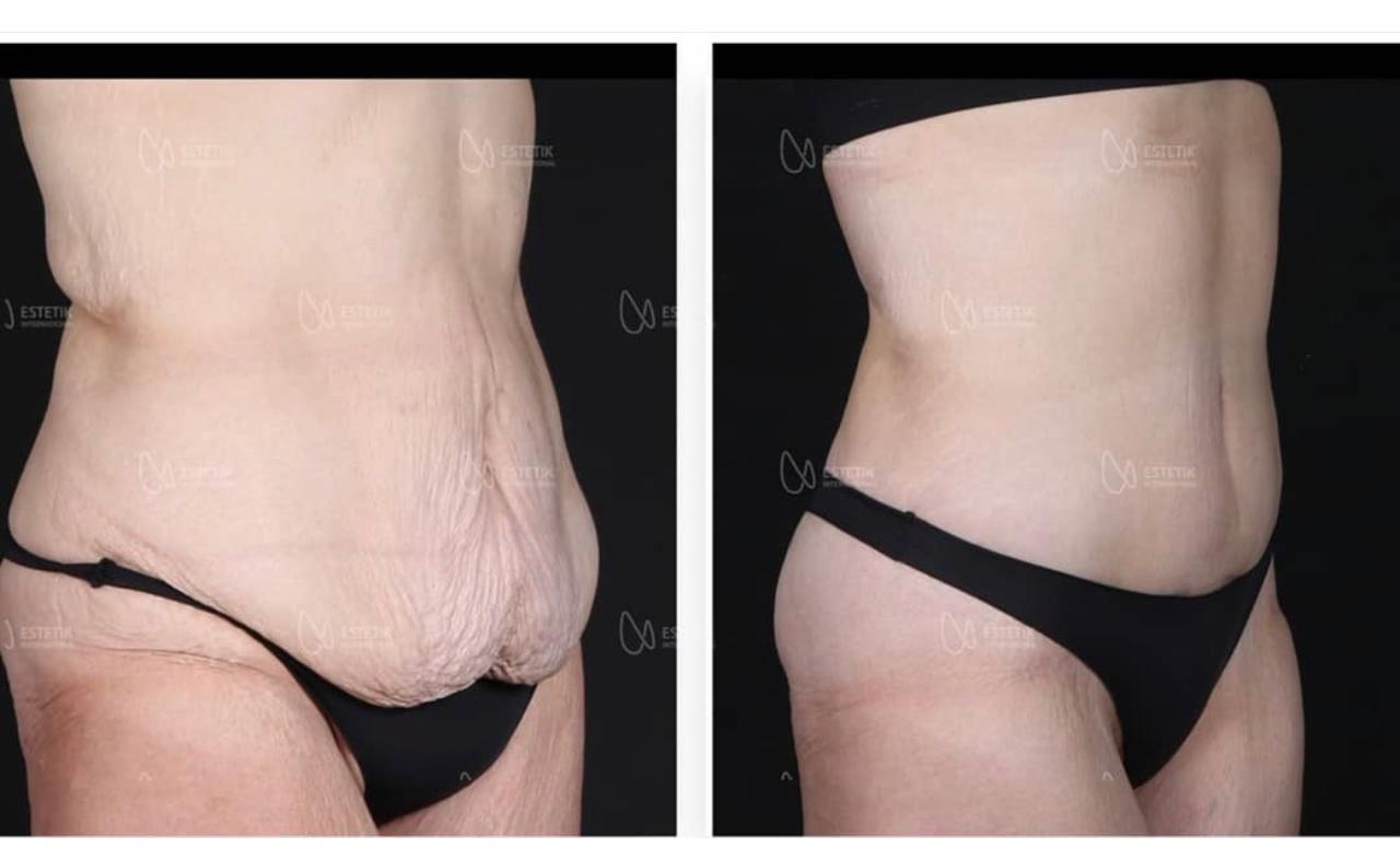 Before and after result by Dr. Selçuk Aytaç