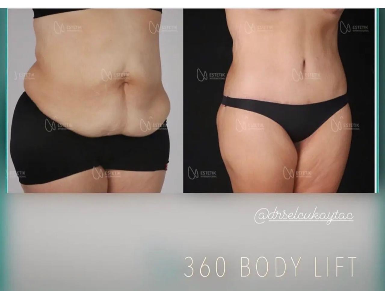 Before and after result by Dr. Selçuk Aytaç