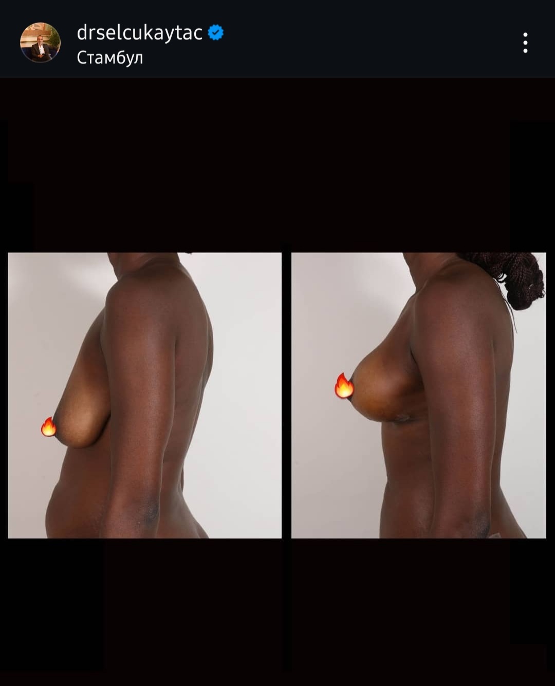 Before and after result by Dr. Selçuk Aytaç