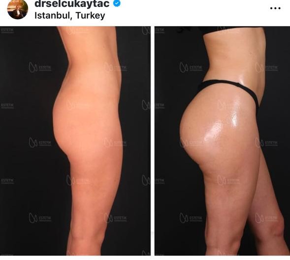 Before and after result by Dr. Selçuk Aytaç
