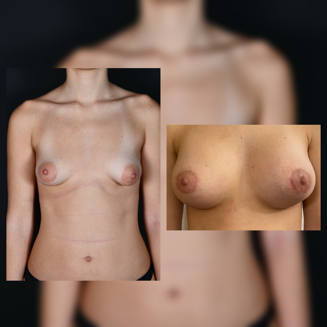 Before and after result by Dr. Selçuk Aytaç