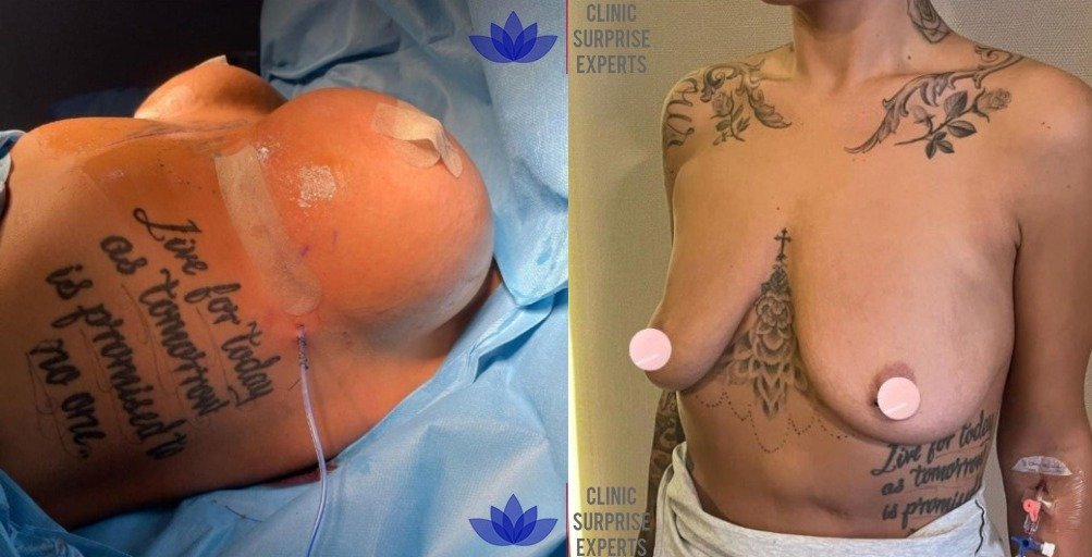 Before and after result by Dr. Taha Sönmez