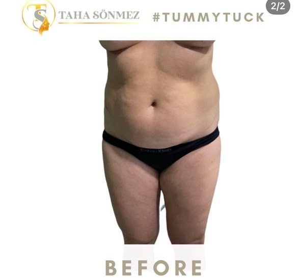 Before and after result by Dr. Taha Sönmez