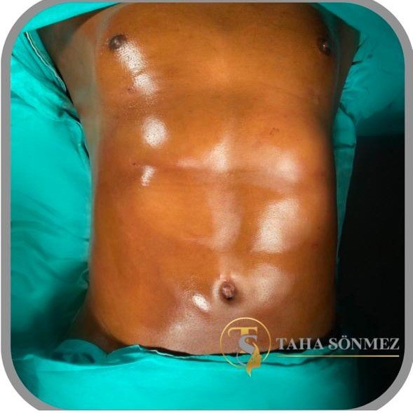 Before and after result by Dr. Taha Sönmez