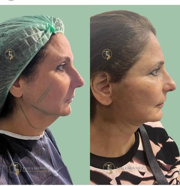 Before and after result by Dr. Taha Sönmez