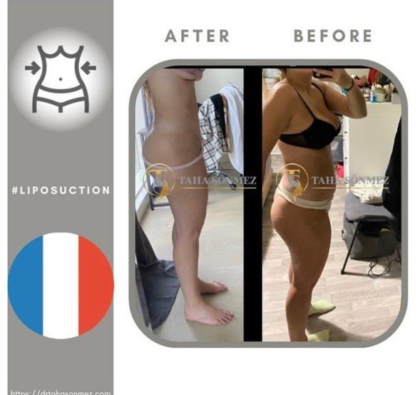 Before and after result by Dr. Taha Sönmez