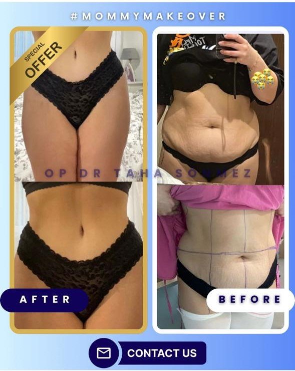 Before and after result by Dr. Taha Sönmez