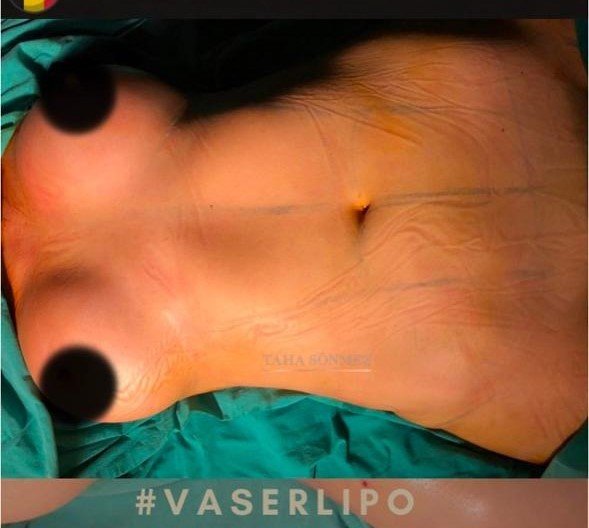 Before and after result by Dr. Taha Sönmez