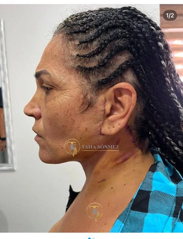 Before and after result by Dr. Taha Sönmez