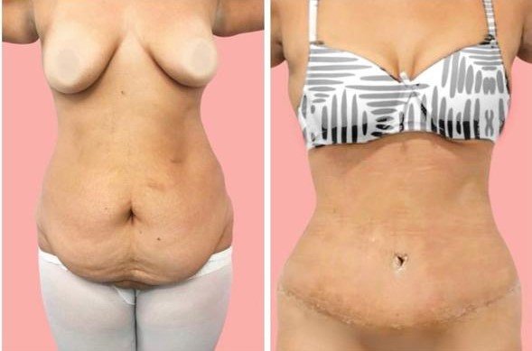 Before and after result by Dr. Taha Sönmez