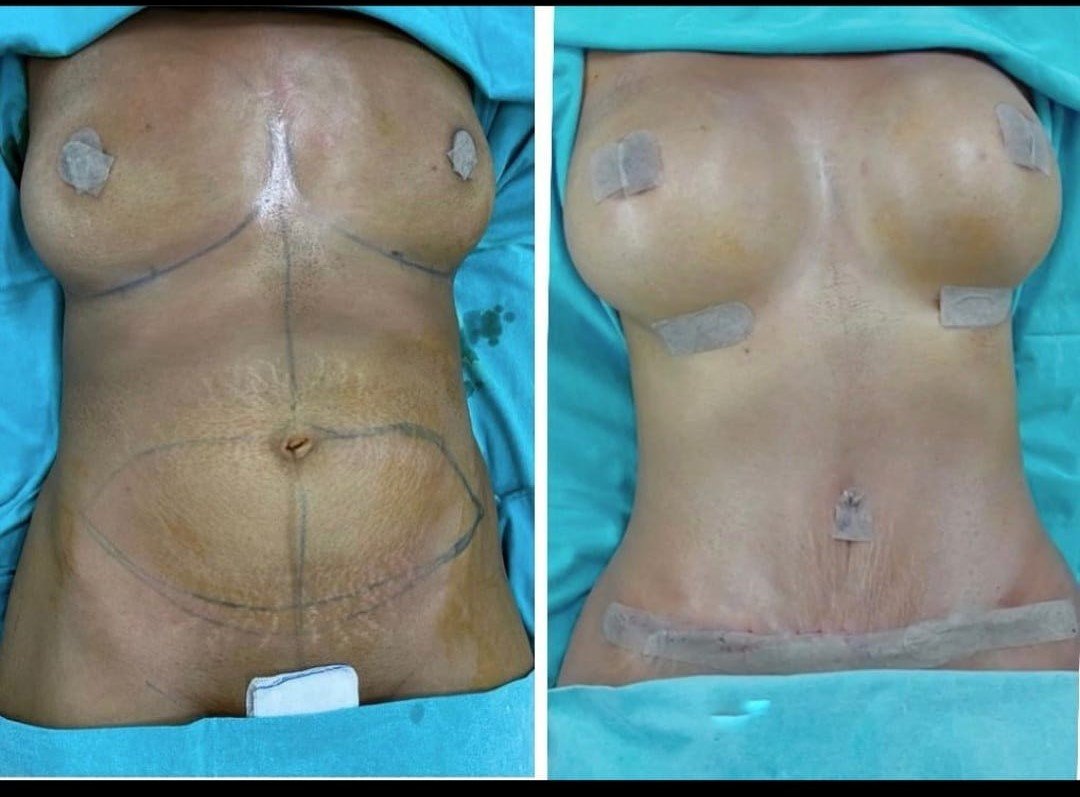 Before and after result by Dr. Taha Sönmez