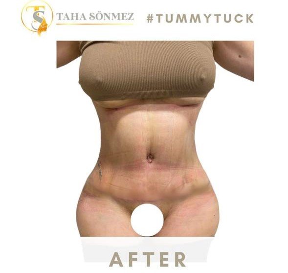 Before and after result by Dr. Taha Sönmez