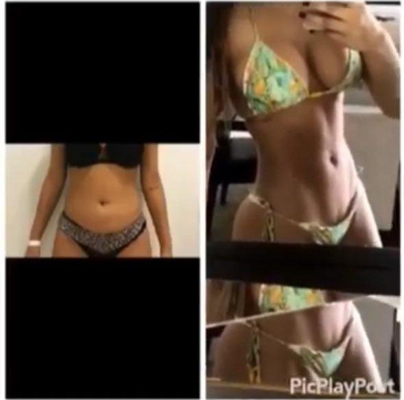 Before and after result by Dr. Taha Sönmez
