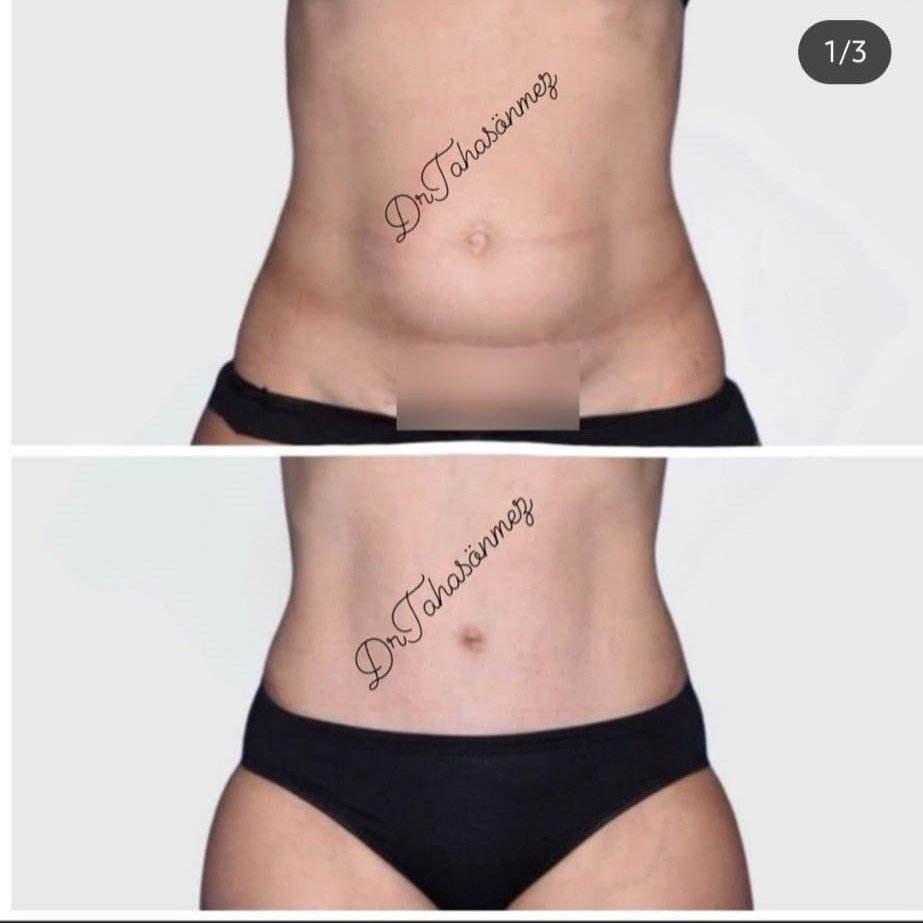 Before and after result by Dr. Taha Sönmez
