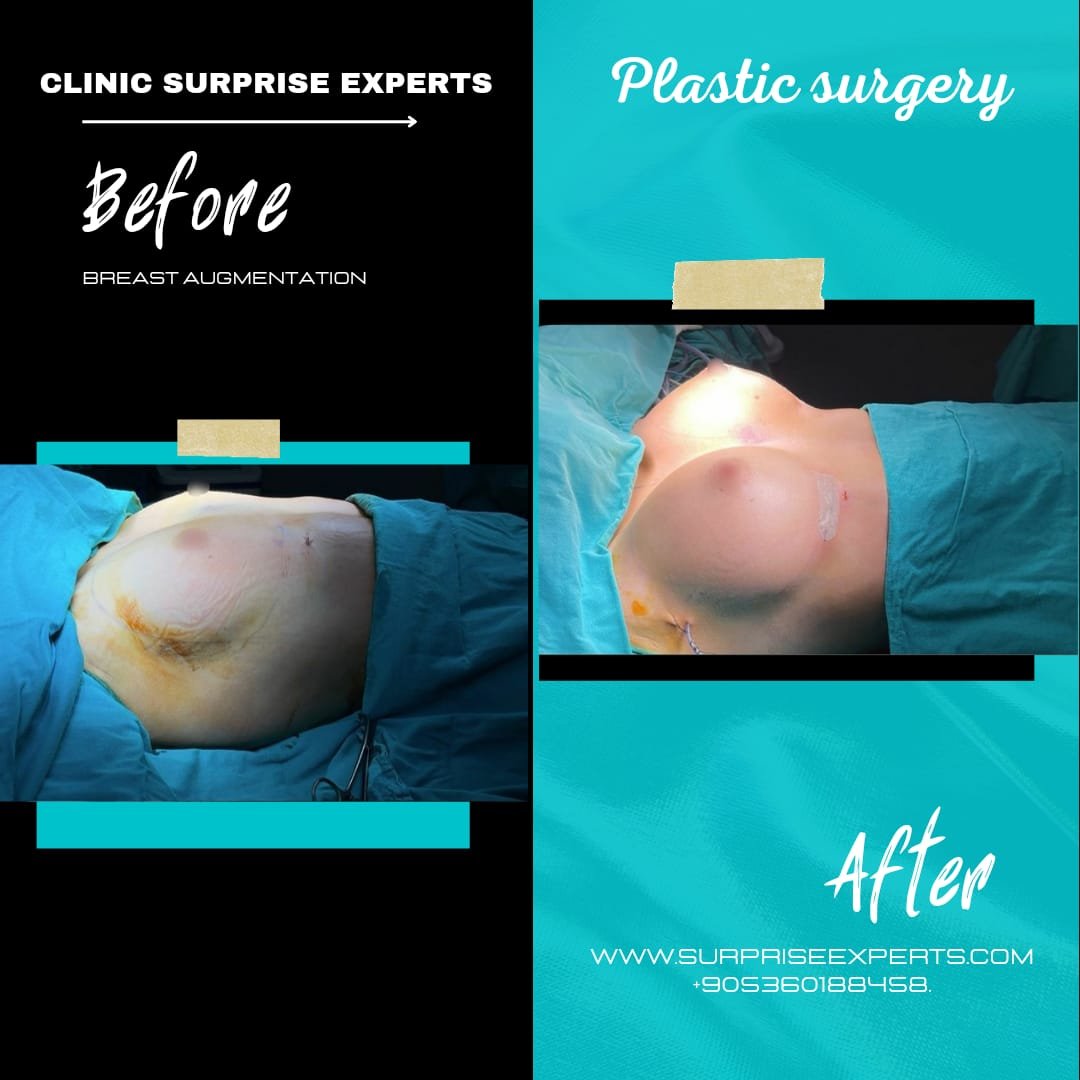 Before and after result by Dr. Taha Sönmez