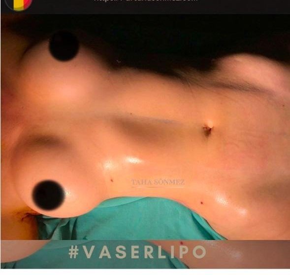 Before and after result by Dr. Taha Sönmez