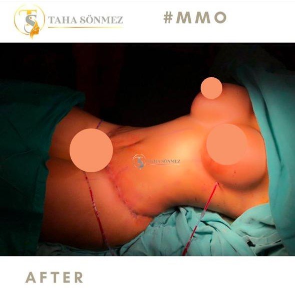 Before and after result by Dr. Taha Sönmez