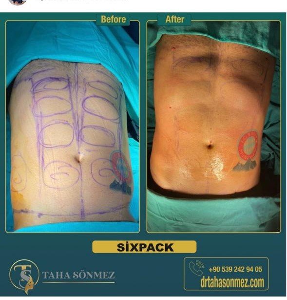 Before and after result by Dr. Taha Sönmez