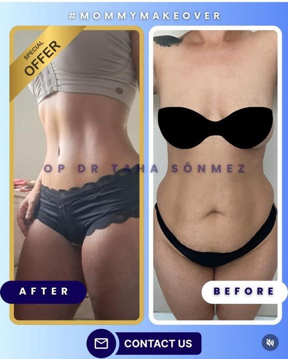 Before and after result by Dr. Taha Sönmez