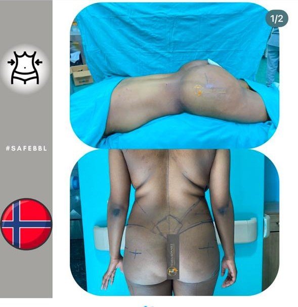 Before and after result by Dr. Taha Sönmez