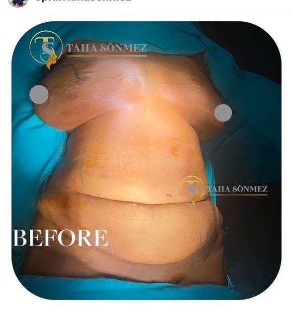 Before and after result by Dr. Taha Sönmez