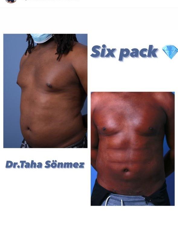 Before and after result by Dr. Taha Sönmez