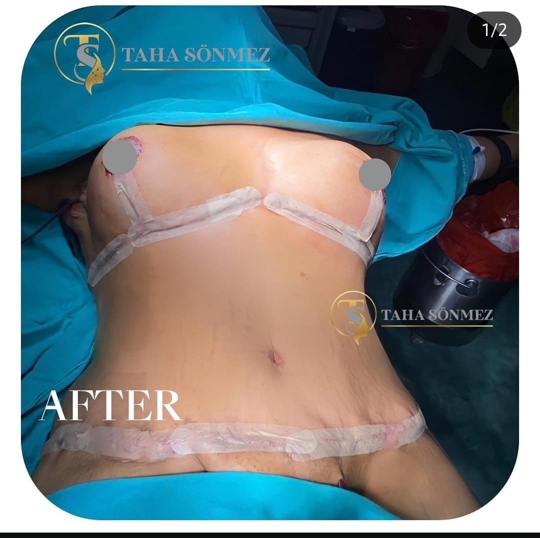 Before and after result by Dr. Taha Sönmez