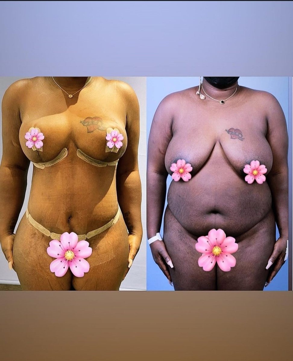 Before and after result by Dr. Taha Sönmez