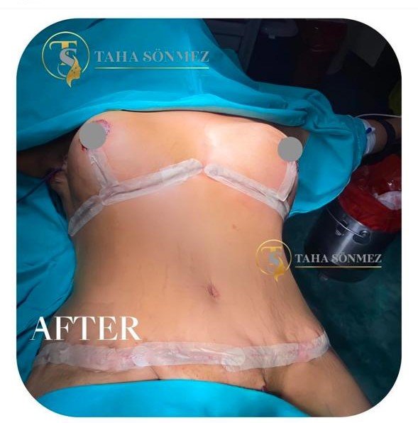 Before and after result by Dr. Taha Sönmez