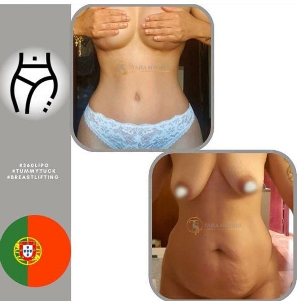 Before and after result by Dr. Taha Sönmez