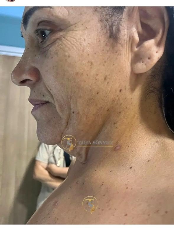 Before and after result by Dr. Taha Sönmez