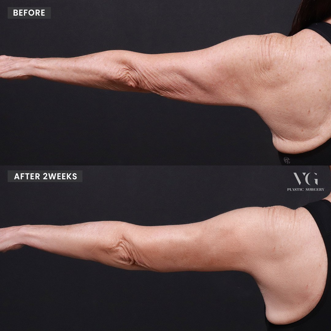 Before and after result by Dr. Im Young Min