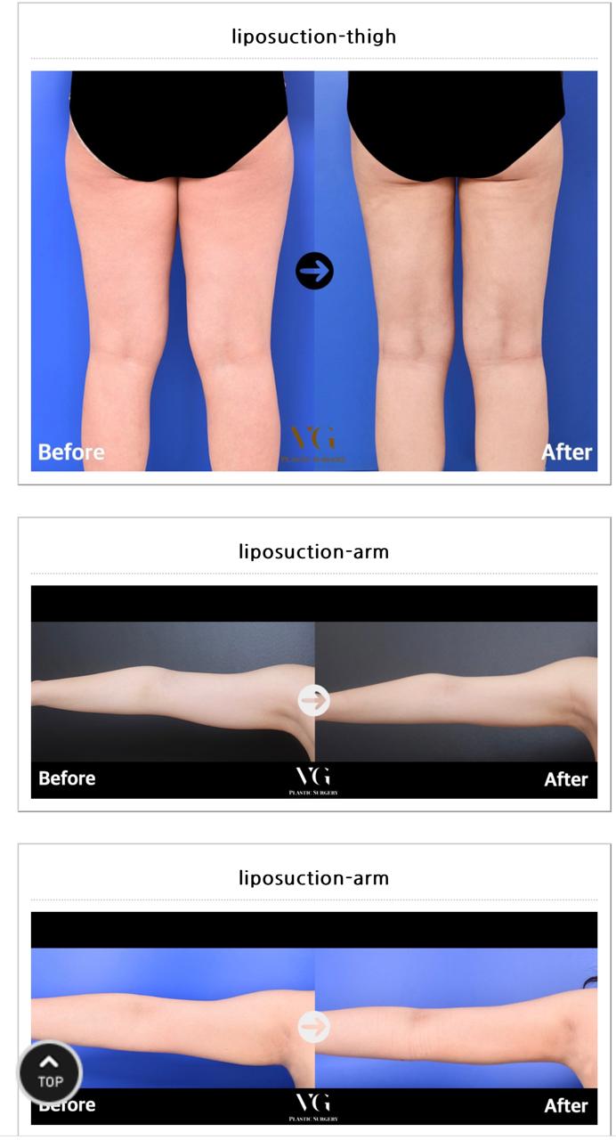 Before and after result by Dr. Kim Yong Woo