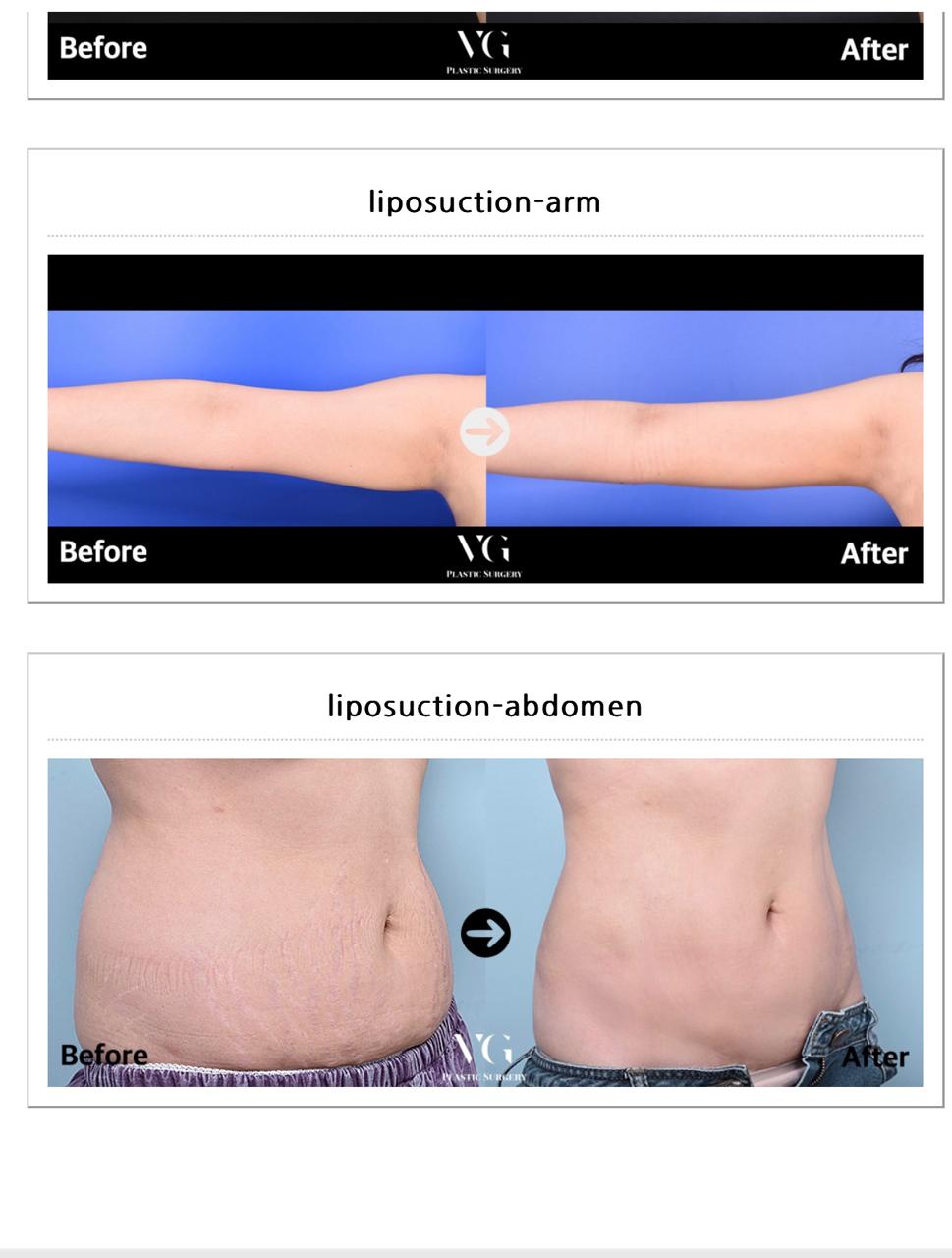 Before and after result by Dr. Im Young Min