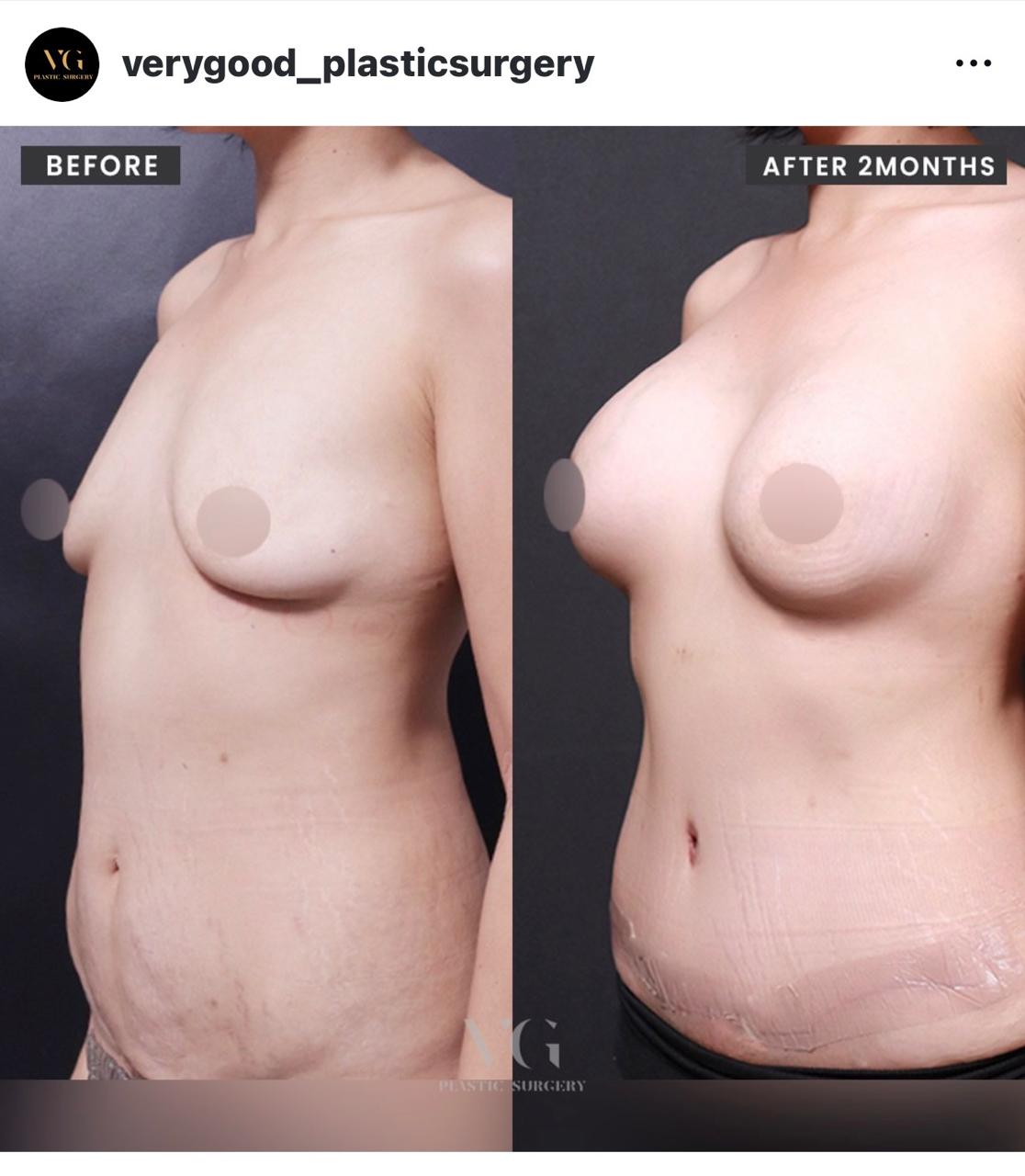 Before and after result by Dr. Im Young Min