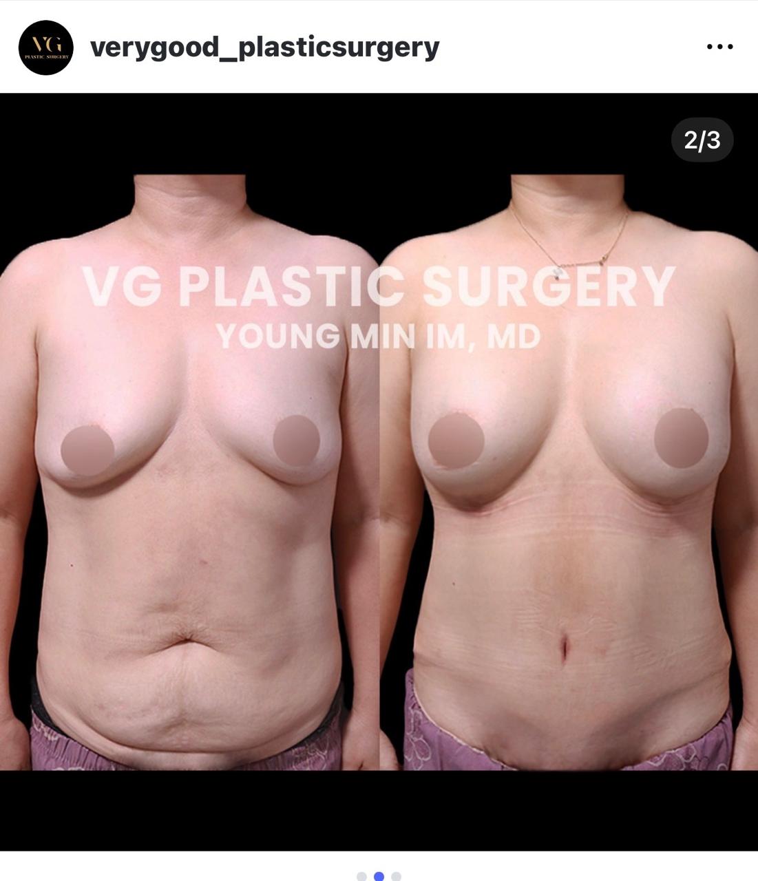 Before and after result by Dr. Im Young Min