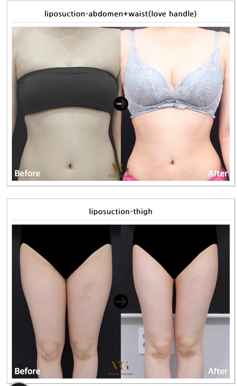 Before and after result by Dr. Kim Yong Woo