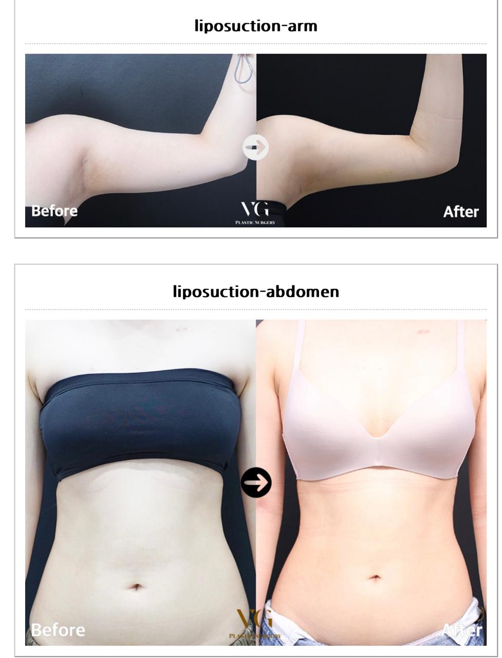 Before and after result by Dr. Im Young Min